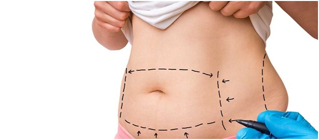 Achieve The Perfect Body Shape With A Vaser Liposuction